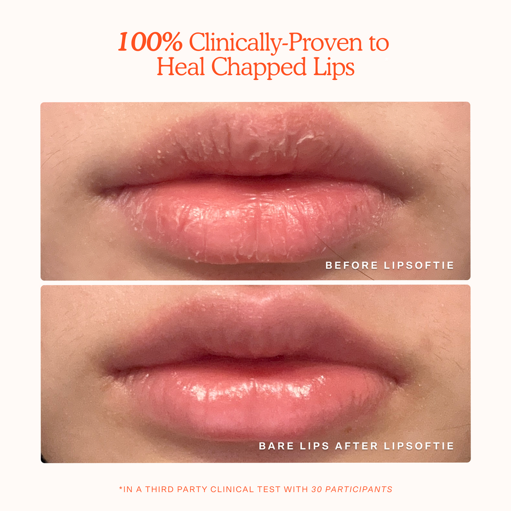 LipSoftie® Lip Treatment M0