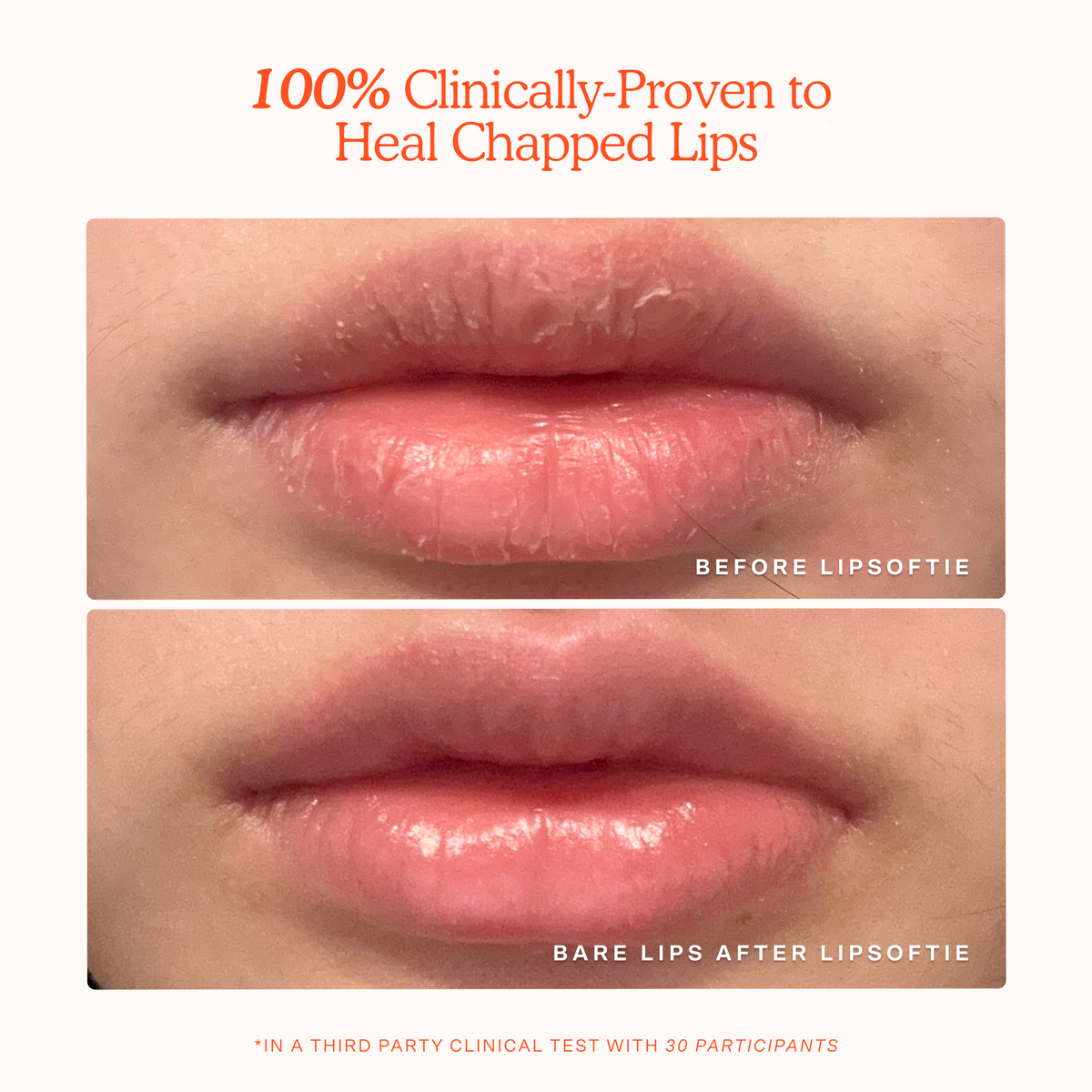 LipSoftie® Lip Treatment M0