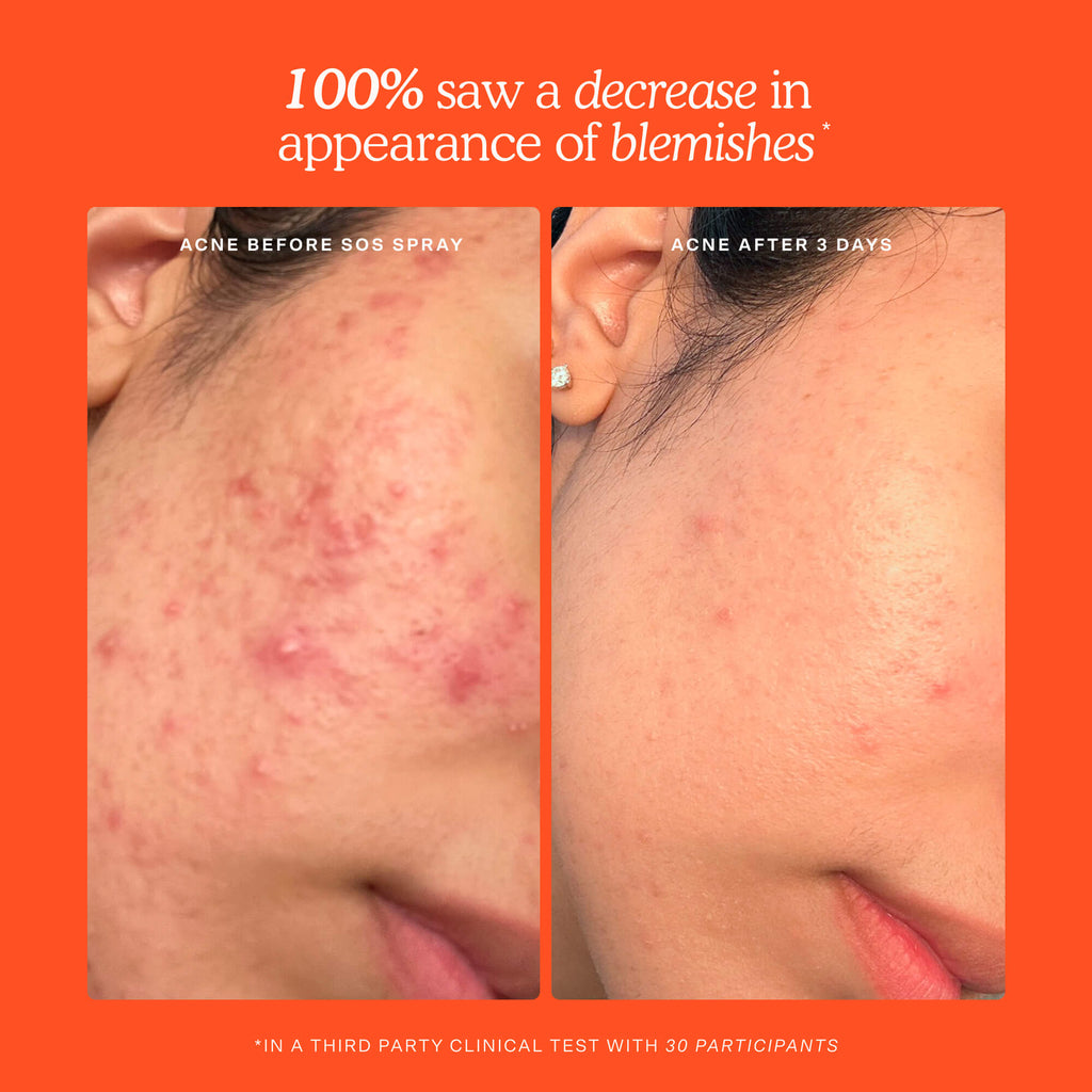 SOS Skincare Minis Kit Y0