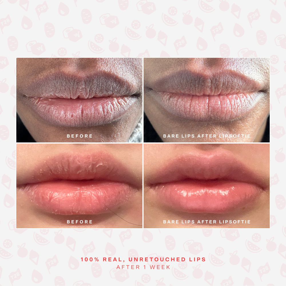 SOS LipSoftie® Lip Treatment S9