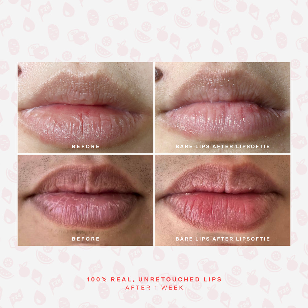 SOS LipSoftie® Lip Treatment U0