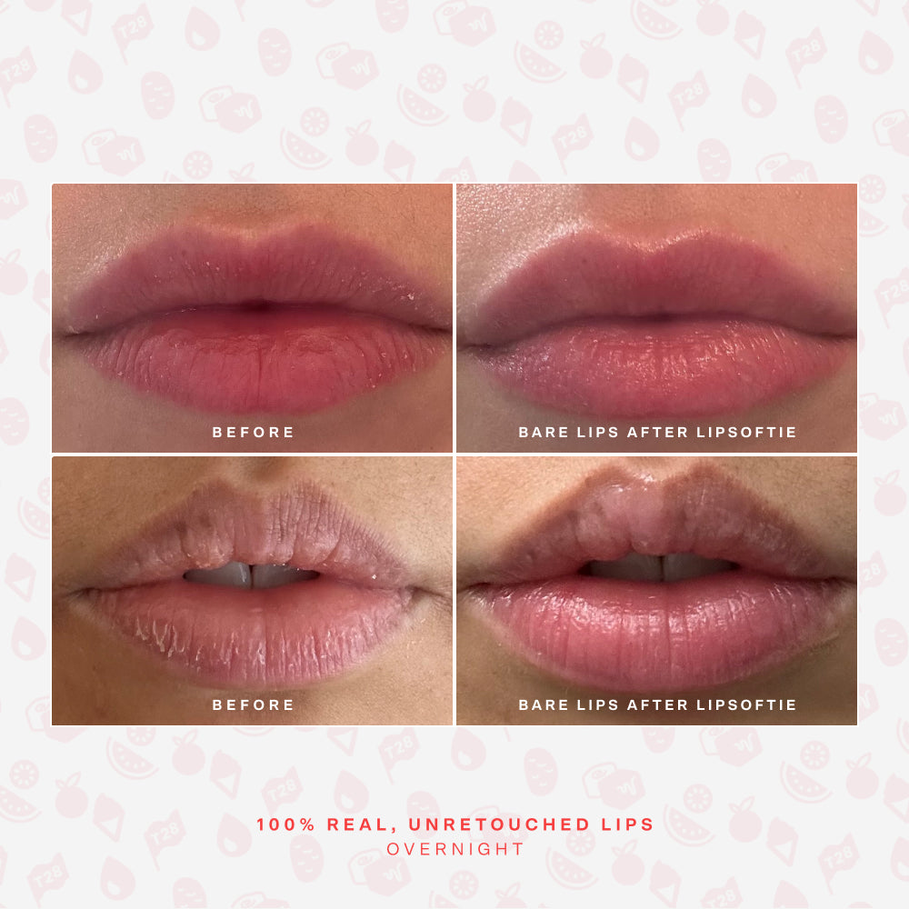 SOS LipSoftie® Lip Treatment U0
